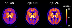 Novel PET imaging agent detects earliest signs of Alzheimer's disease – EurekAlert