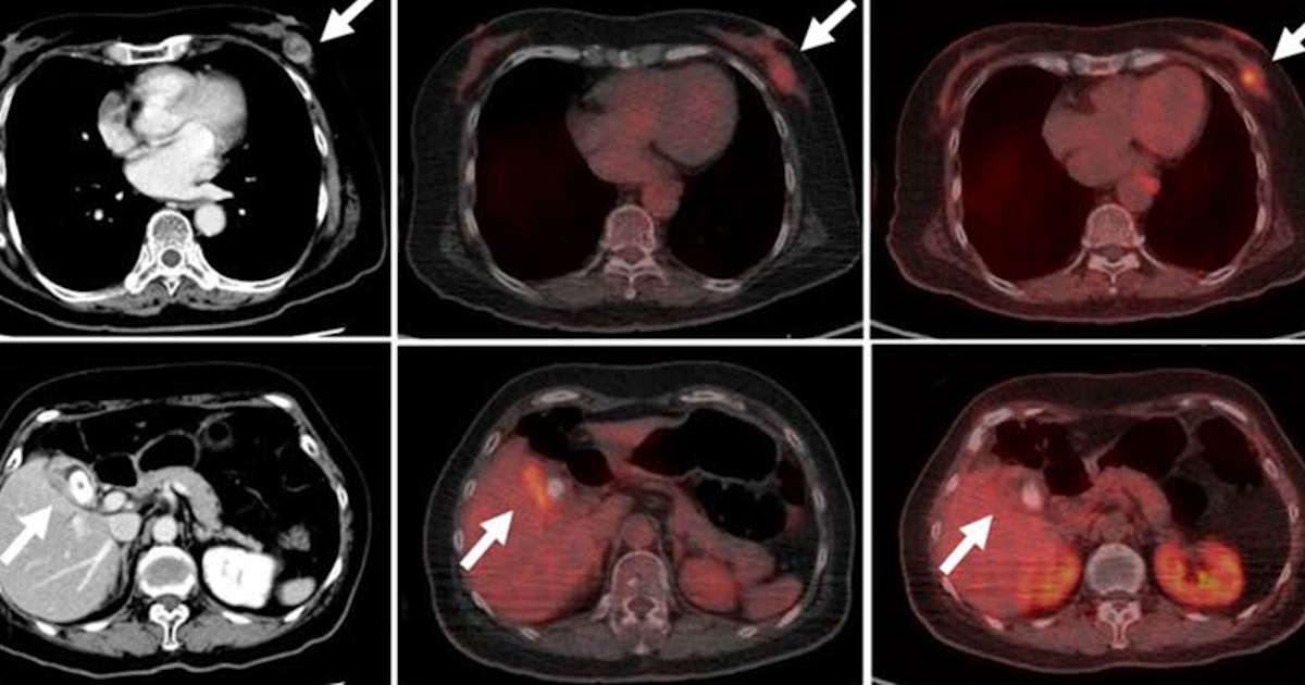 FBPA-PET can differentiate between malignant and benign lesions – AuntMinnie